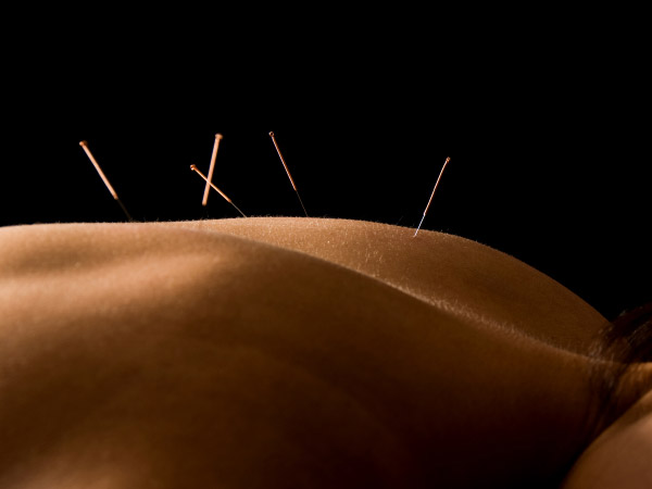 Acupuncture Services Brisbane